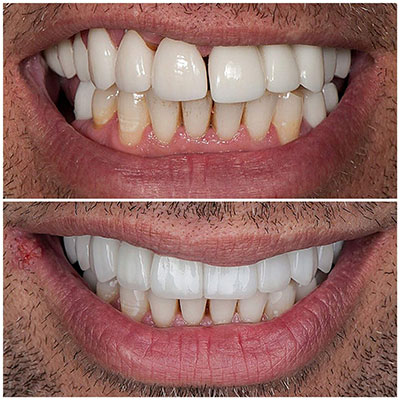 Smile transformation before and after cosmetic treatment at Carrollwood Smiles, Tampa FL