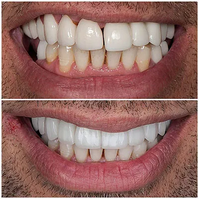 Smile transformation before and after cosmetic treatment at Carrollwood Smiles, Tampa FL