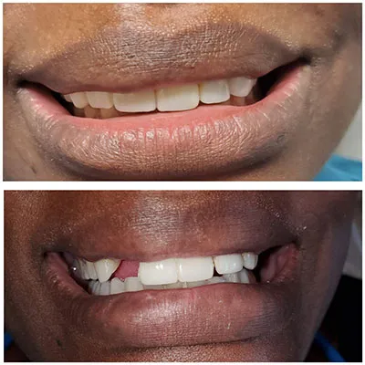 Smile transformation before and after cosmetic treatment at Carrollwood Smiles, Tampa FL