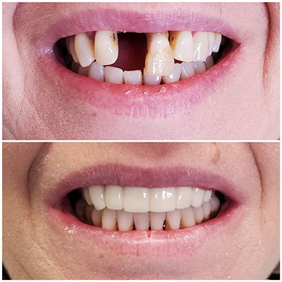 Smile transformation before and after dental treatment at Carrollwood Smiles, Tampa FL