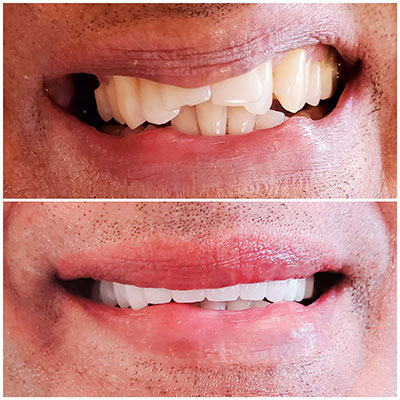 Smile transformation before and after dental treatment at Carrollwood Smiles, Tampa FL