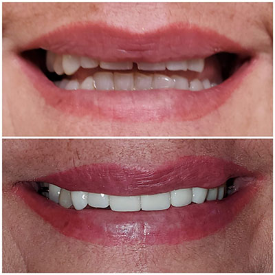Smile transformation before and after treatment at Carrollwood Smiles, Tampa FL
