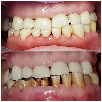 Smile transformation before and after treatment at Carrollwood Smiles, Tampa FL