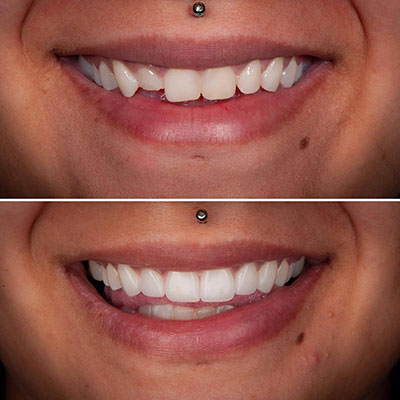Smile transformation before and after treatment at Carrollwood Smiles, Tampa FL