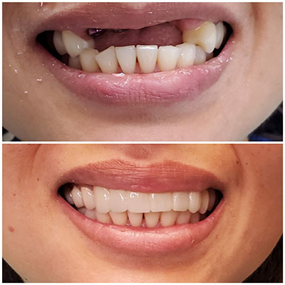 Smile transformation before and after treatment at Carrollwood Smiles, Tampa FL